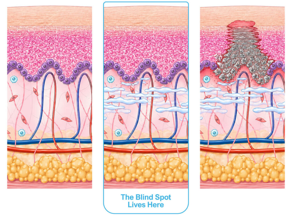 Pressure Injury Prevention Blind Spot