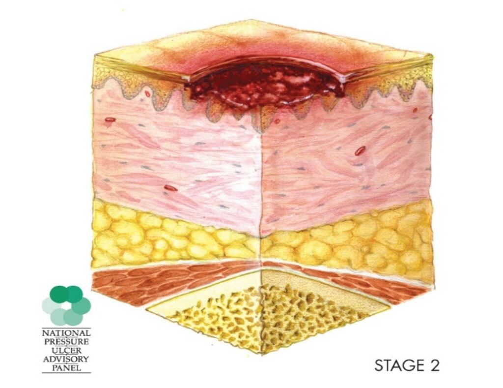pressure injury stage 2