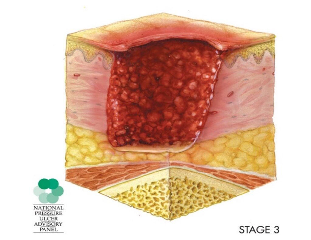 pressure injury stage 3