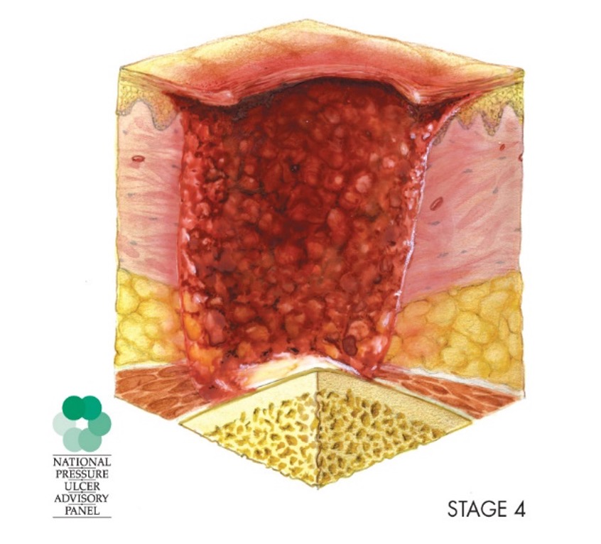 pressure injury stage 4
