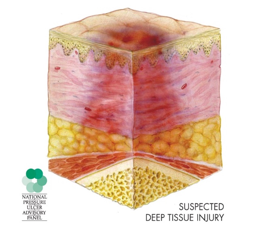 deep tissue pressure injury