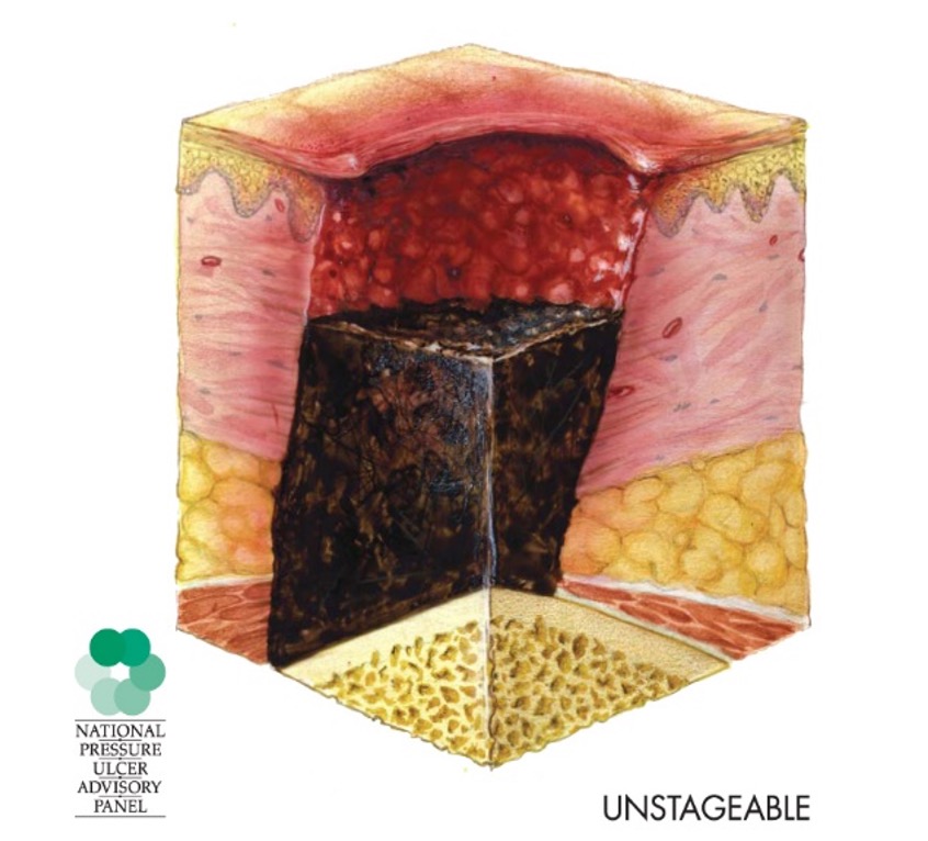 Unstageable Pressure Injury